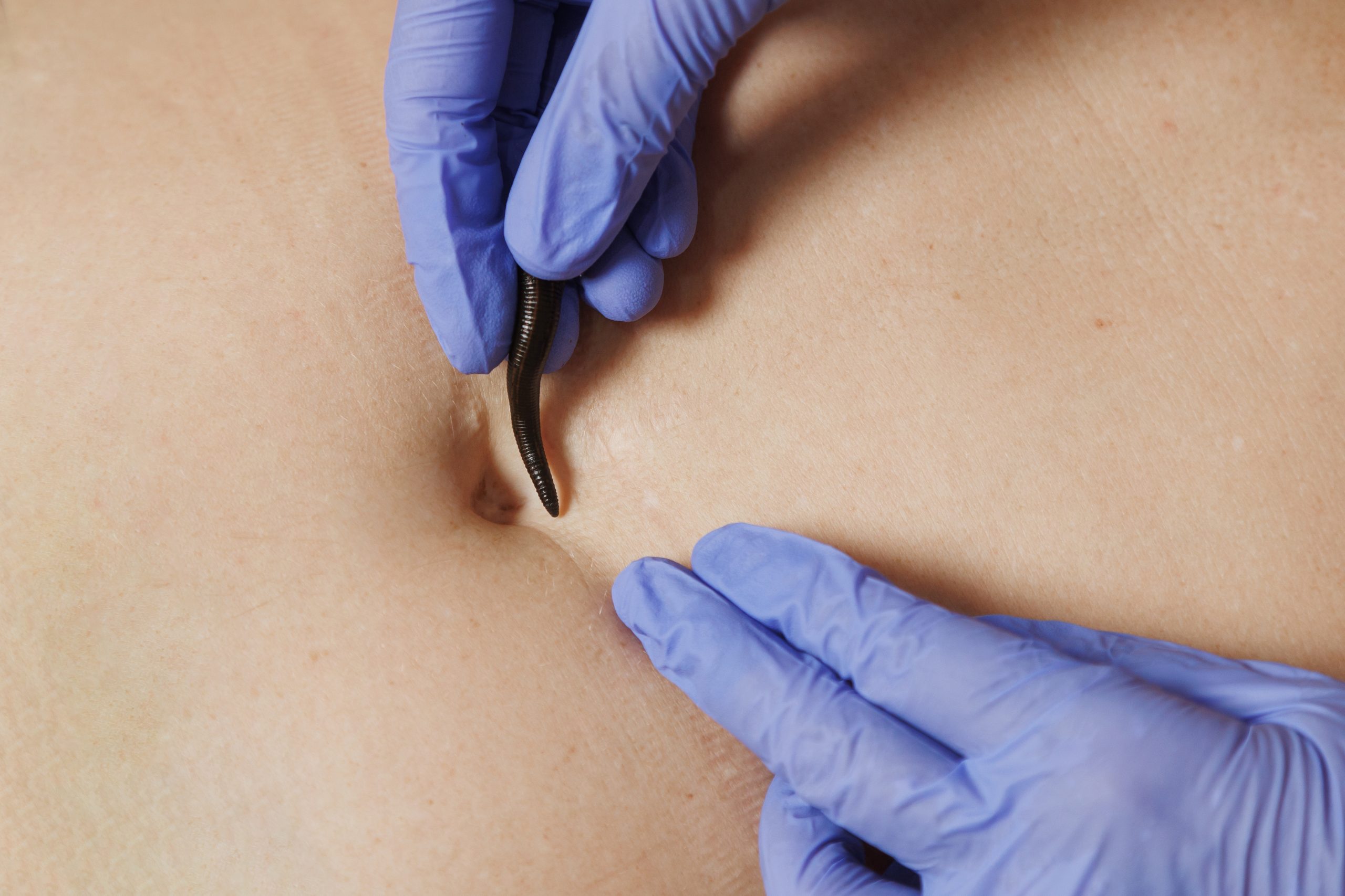 Гирудотерапия 1 Гирудотерапия